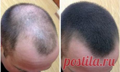 Как вырастить волосы на лысине: причины, рецепты Лысина у мужчины: как можно восстановить волосы Причины облысения Как правило, мужчины начинают лысеть с макушки и передней части черепа. Многим женщинам лысый мужчина кажется более сексуальным и привлекательным. Но большая часть сильного пола при появлении подобной проблемы обеспокоена потерей волос. Зачастую это прив