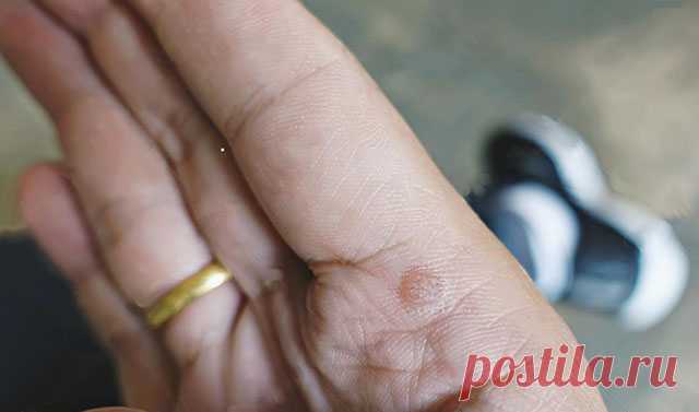 Простой способ избавиться от бородавок. Народные средства. — Домашние заботы