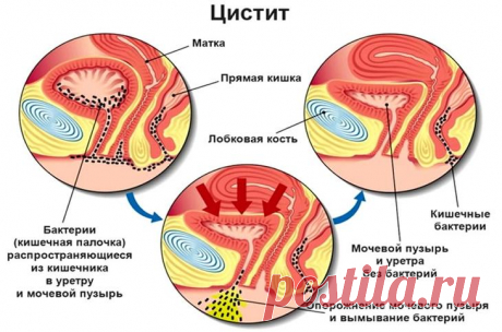 Цистит у женщин: лечение в домашних условиях