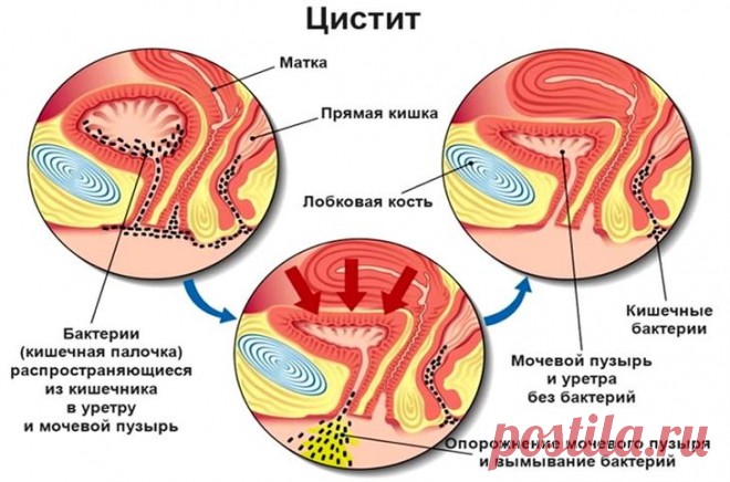 Цистит у женщин: лечение в домашних условиях