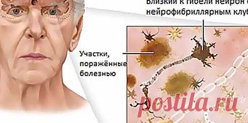 Экология здоровья: Болезнь Альцгеймера — это разрушительное дегенеративное заболевание мозга. От нее не существует традиционного лечения, а, когда болезнь..
