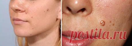 Папилломы на коже — симптомы заражения паразитами!