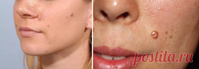 Папилломы на коже — симптомы заражения паразитами!