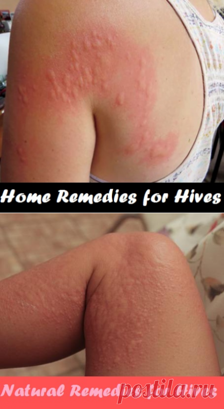 Home Remedies for Hives | Virtual Clinic