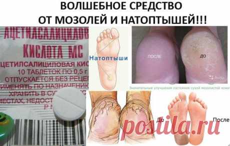 КОПЕЕЧНОЕ СРЕДСТВО ОТ МОЗОЛЕЙ И НАТОПТЫШЕЙ
