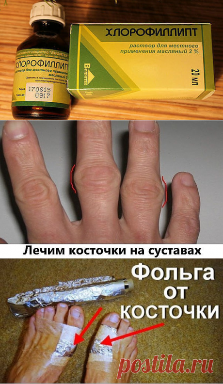 ТЕБЕ ПОНАДОБИТСЯ:масляный раствор«Хлорофиллипт»,«Димексид»
ПРИМЕНЕНИЕ:1. Возьми шприц и набери 3 кубика масляного раствора «Хлорофиллипт». Вылей жидкость в пластиковый стакан или любую другую чистую емкость.2. Далее набери 1 кубик «Димексида» и смешай препарат с «3. Нанеси лечебную смесь на ватный тампон и помести на косточку. Эту процедуру следует проводить утром и вечером, держать компресс нужно 15 минут.