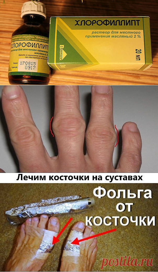 ТЕБЕ ПОНАДОБИТСЯ:масляный раствор«Хлорофиллипт»,«Димексид»
ПРИМЕНЕНИЕ:1. Возьми шприц и набери 3 кубика масляного раствора «Хлорофиллипт». Вылей жидкость в пластиковый стакан или любую другую чистую емкость.2. Далее набери 1 кубик «Димексида» и смешай препарат с «3. Нанеси лечебную смесь на ватный тампон и помести на косточку. Эту процедуру следует проводить утром и вечером, держать компресс нужно 15 минут.