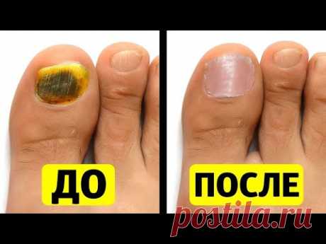 Копеечное сильнейшее средство от грибка ногтей// Как  Вылечить Грибок на ногах и ногтях дома