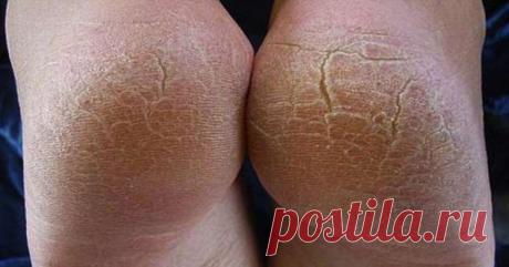 4 домашних увлажняющих кремов для сухих пяток | Люблю Себя