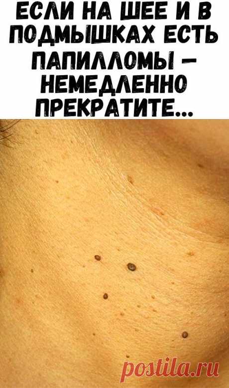 Если на шее и в подмышках есть папилломы — немедленно прекратите… - Советы и Рецепты Папилломы на коже — это доброкачественные новообразования, вызванные папилломавирусом человека (ВПЧ). Они являются больше косметической проблемой, нежели медицинской. Удалить их на самом деле совершенно несложно. Процедуру можно проделать даже в домашних условиях! 
Но в целом людей больше всего смущает их внешний вид, и поэтому они хотят по скорее от них избавиться любым способом.