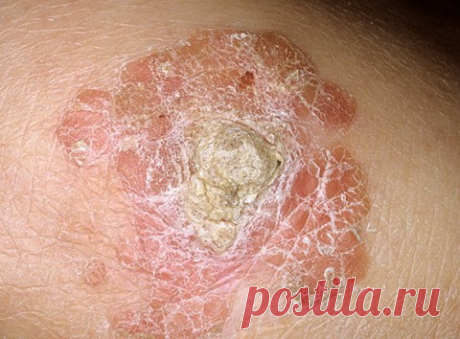 16 тип вируса папилломы лечение народными средствами