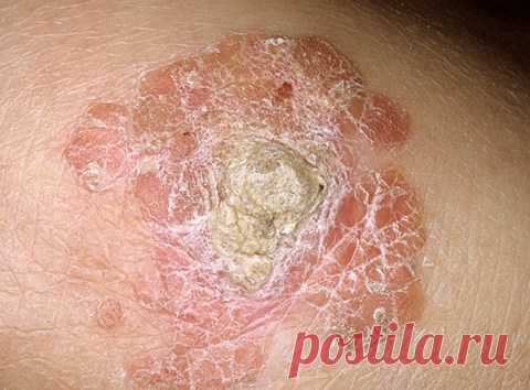 16 тип вируса папилломы лечение народными средствами