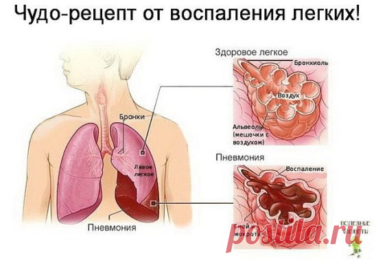 ЛЕЧЕНИЕ И СРЕДСТВО ОТ ВОСПАЛЕНИЯ ЛЕГКИХ