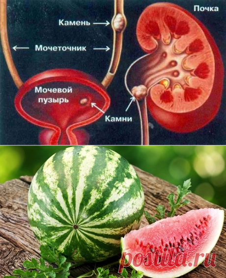Лечение мочекаменной болезни народными средствами