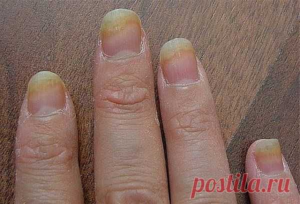 Болезни ногтей | Похудей навсегда