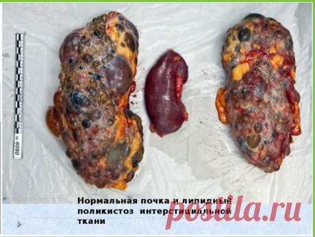 Психология - КАК ПОБЕДИТЬ КАМНИ В ПОЧКАХ..