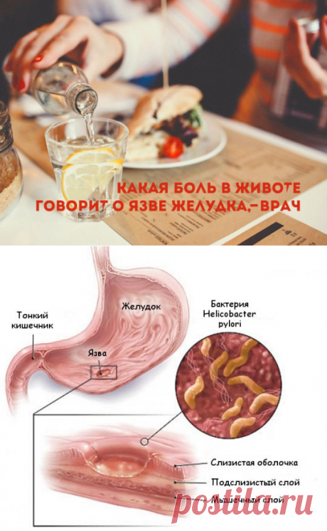 Признаки язвы желудка