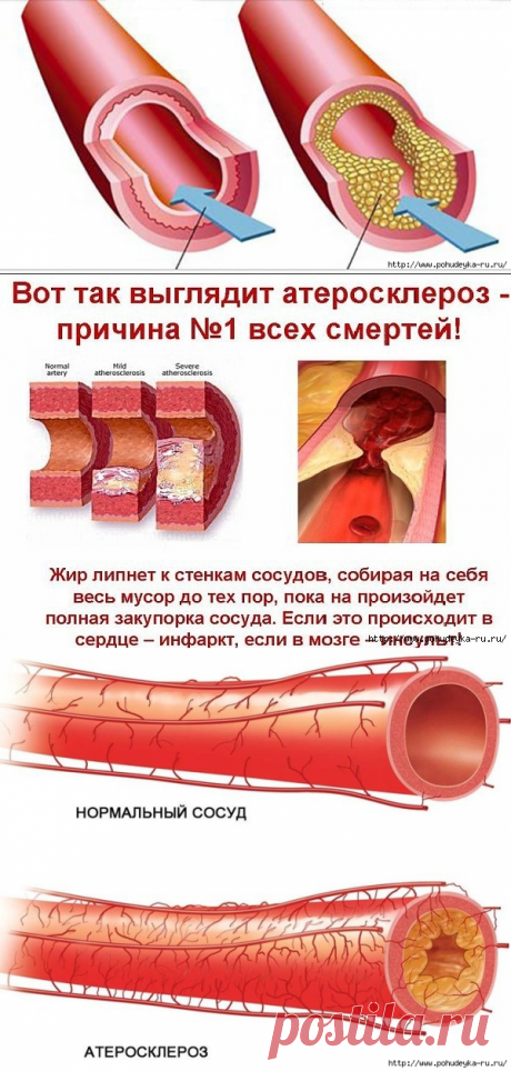 Скрытые признаки забитых артерий и лучшие продукты для предотвращения этого!