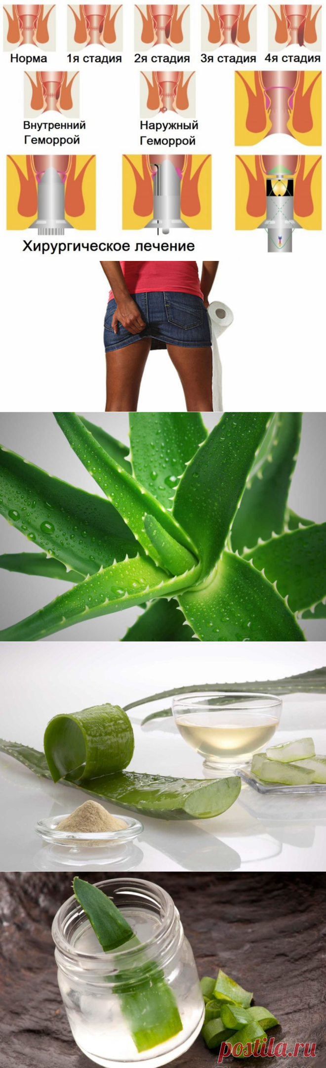 Алоэ при геморрое [7 проверенных рецептов] ⋆Отзывы⋆