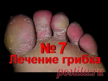 Лечение грибка на ногах народными средствами | перекись водорода- уксус - спирт | #edblack