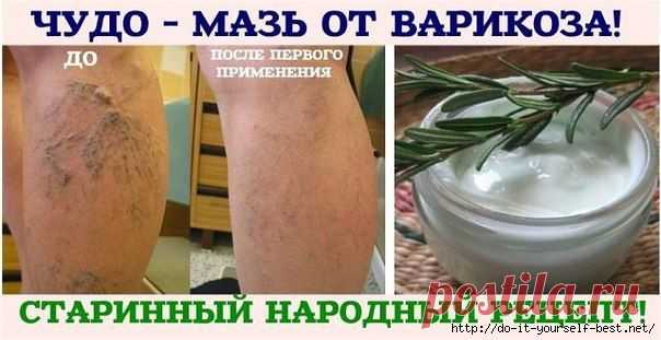 ЧУДО - МАЗЬ ОТ ВАРИКОЗА!.