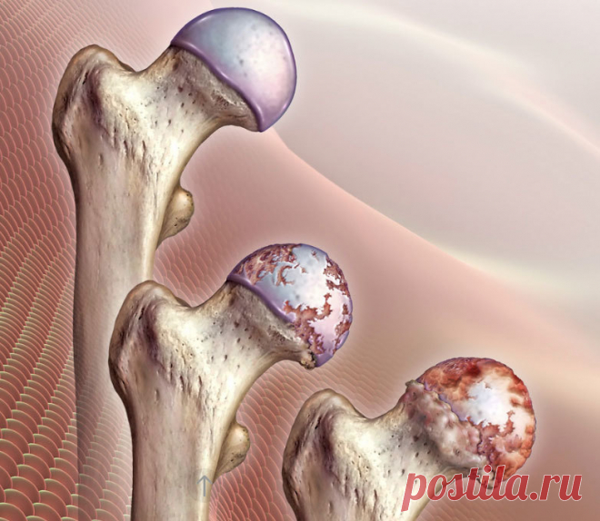Упражнения и методы лечения коксартроза тазобедренного сустава Коксартроз суставов – это заболевание, при котором имеет место постепенное разрушение хряща и деформация костных поверхностей сустава, что со временем приводит к ограничению подвижности сустава и нарушению движения