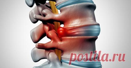 Как вылечить межпозвоночную грыжу при помощи физических упражнений