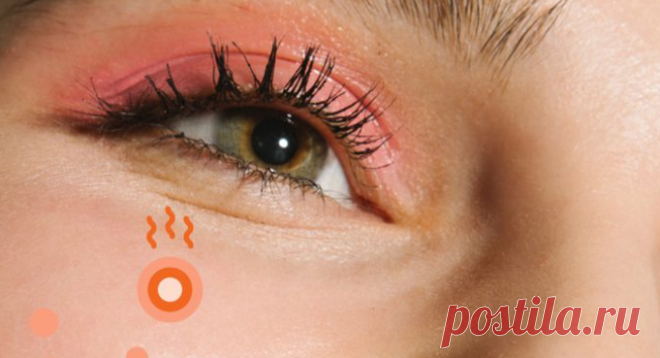 С биологической точки зрения любые прыщи — это активизация сальных желез, функции секреции. С психологической точки зрения прыщи появляются, когда событие, ситуация воспринимается как угроза атаки. И, опять же, происходит усиление работы сальных желез.