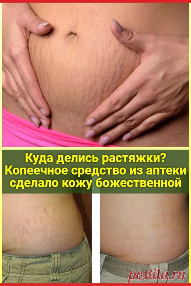 Куда делись растяжки? Копеечное средство из аптеки сделало кожу божественной