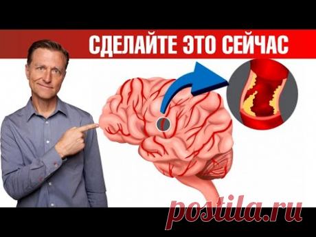 Профилактика инсульта и микроинсульта. Защитите себя ✅