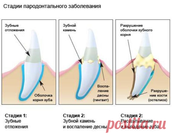 Рецепты народной медицины при пародонтозе и кровотечении десен