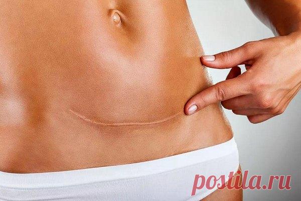 УЗИ после кесарева сечения: как делают исследование шва и рубца на матке, таблица нормы размеров матки, когда и как часто проводят, что показывает ультразвук и как расшифровать картинку