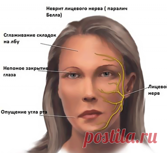 Лечебная гимнастика при НЕВРИТЕ лицевого нерва Экология жизни: Здоровье.В процессе процедур лечебной гимнастики выполнение специальных упражнений при неврите рекомендуется осуществлять перед зеркалом (в положении сидя и стоя). Перед каждым упражнением следует расслаблять мышцы, особенно на здоровой стороне. Не следует применять упражнения только для больной стороны, необходимо одновременно проводить упражнения как больной, так и здоровой половины лица, добиваясь симметричн...