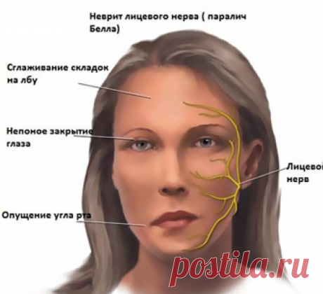 Лечебная гимнастика при НЕВРИТЕ лицевого нерва Экология жизни: Здоровье.В процессе процедур лечебной гимнастики выполнение специальных упражнений при неврите рекомендуется осуществлять перед зеркалом (в положении сидя и стоя). Перед каждым упражнением следует расслаблять мышцы, особенно на здоровой стороне. Не следует применять упражнения только для больной стороны, необходимо одновременно проводить упражнения как больной, так и здоровой половины лица, добиваясь симметричн...