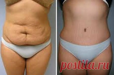 Мой опыт на белковой диете: скинула 17 кг и убрала жир на животе за 1 месяц

Висячий животик и объемные бедра проблема женщин испытавших счастье материнства. Я расползлась в нижней части фигуры как-то незаметно, спустя два года после родов. Новый облик мне не понравился решительно.

Только вернуться к прежнему размеру не удавалось. Физические упражнения приносили жуткие мигрени, а сокращение приемов пищи не давали видимых результатов. Заинтересовала белковая диета.