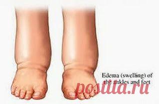Чтобы отеки не мешали | Друг пенсионера