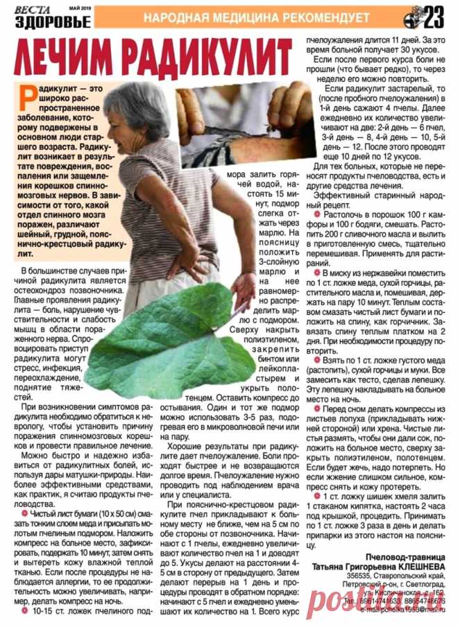 Лечим радикулит