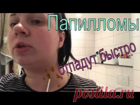 💥ПАПИЛЛОМЫ💥 как я удаляла народными средствами