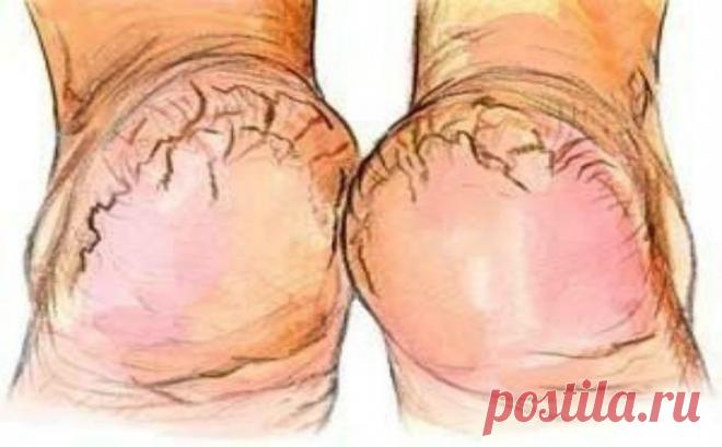 Крем «Безупречные пяточки!»…не сравнится ни с одним покупным!