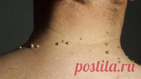 Аптечные и домашние мази от папиллом — ХОЗЯЮШКА