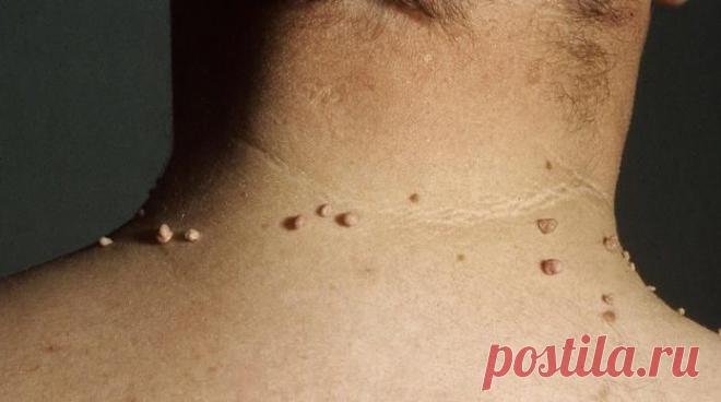 Аптечные и домашние мази от папиллом — ХОЗЯЮШКА