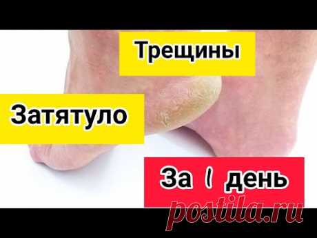 Мгновенный СПОСОБ лечения от ТРЕЩИН на  пятках - YouTube