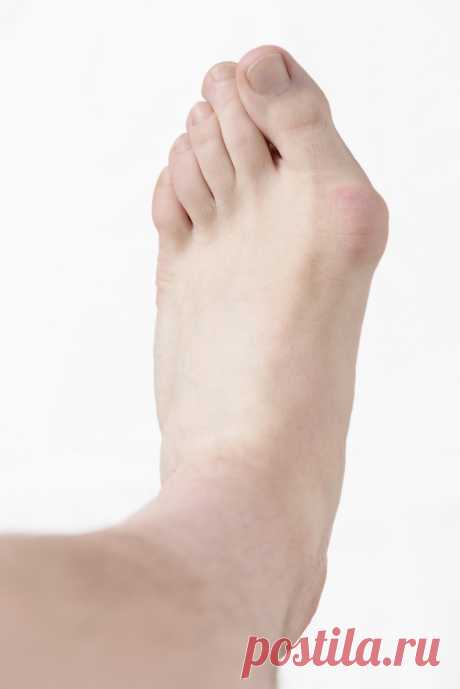Артроз большого пальца стопы - лечение | Лечение окоченения пальцев стопы