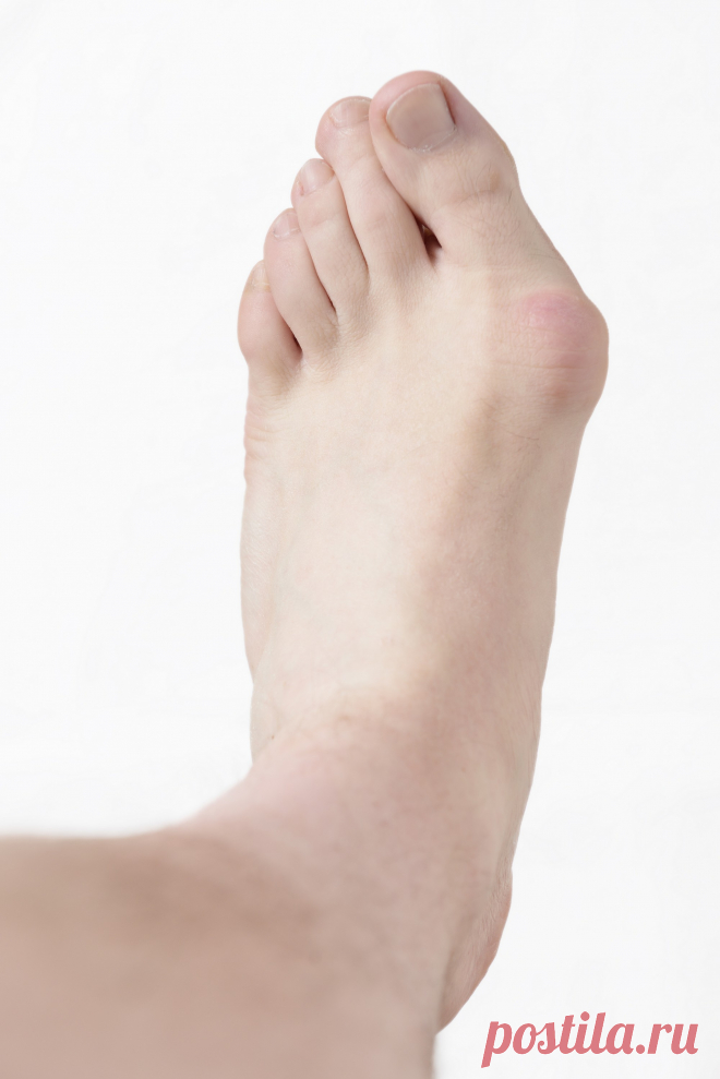 Артроз большого пальца стопы - лечение | Лечение окоченения пальцев стопы
