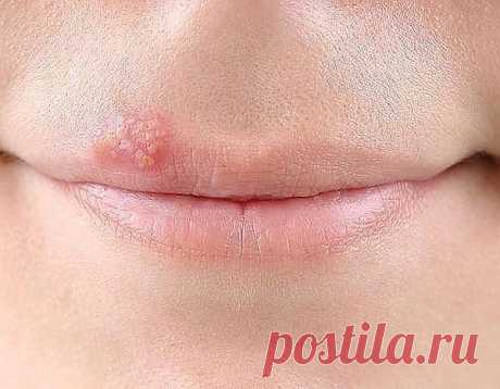 Герпес на губах? Избавимся быстро!  Используйте обычную поваренную соль. 3-4 раза в день прикладывайте к “простуде” несколько крупинок мелкой соли, и герпес заживает гораздо быстрее, чем от любого лекарства.
А еще можно каждый час кла…