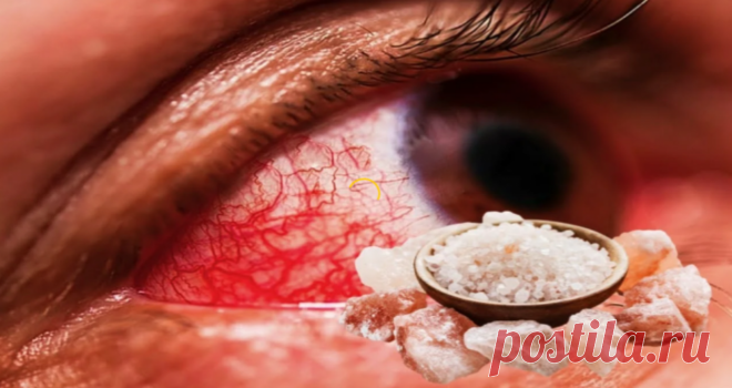 Первая помощь при ячмене Народная Медицина — рецепты для лечения, cекреты и народные средства.