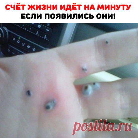 Сначала они были крошечными, но потом начали разрастаться. Муж и жена решили, что это запекшаяся под кожей кровь. Но почему она появилась? Тем временем точки переросли в настоящие волдыри. Было решено использовать антибактериальный крем. Но он не помог! Затем один из волдырей лопнул. Наконец, пара отправилась к врачу. Пришлось оперативным путем удалить все наросты.Врач сказал, что у женщины были гнойные гранулемы. Их может вызвать гормональный дисбаланс или психологическая травма.