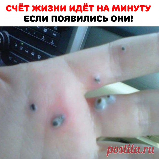 Сначала они были крошечными, но потом начали разрастаться. Муж и жена решили, что это запекшаяся под кожей кровь. Но почему она появилась? Тем временем точки переросли в настоящие волдыри. Было решено использовать антибактериальный крем. Но он не помог! Затем один из волдырей лопнул. Наконец, пара отправилась к врачу. Пришлось оперативным путем удалить все наросты.Врач сказал, что у женщины были гнойные гранулемы. Их может вызвать гормональный дисбаланс или психологическая травма.