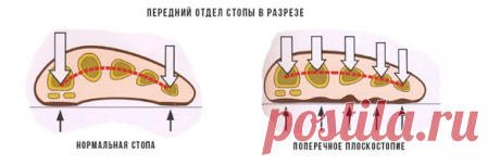 Комплект "Антикосточка"
