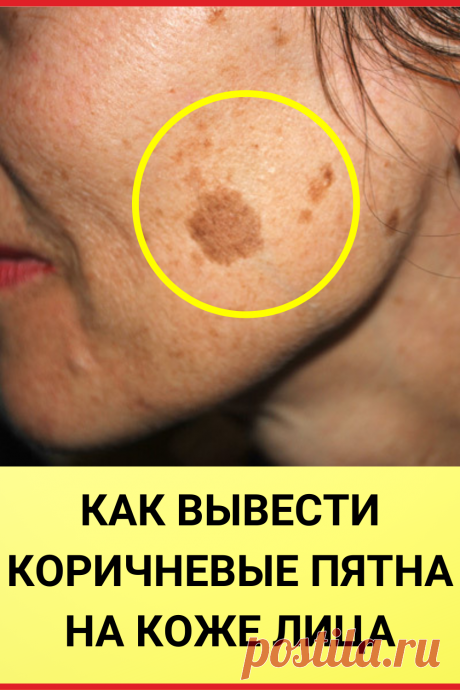 КАК ВЫВЕСТИ КОРИЧНЕВЫЕ ПЯТНА НА КОЖЕ ЛИЦА
